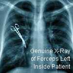 X-Ray of Forceps Left In Chest Cavity